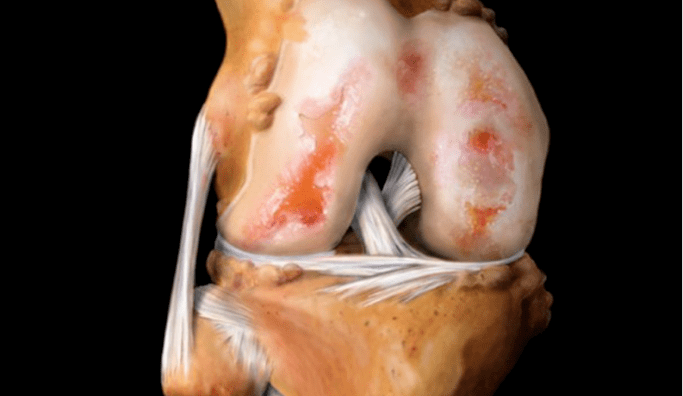 Osteoartrite da articulación do xeonllo