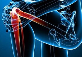 Dor de xeonllos na artrite e artrose