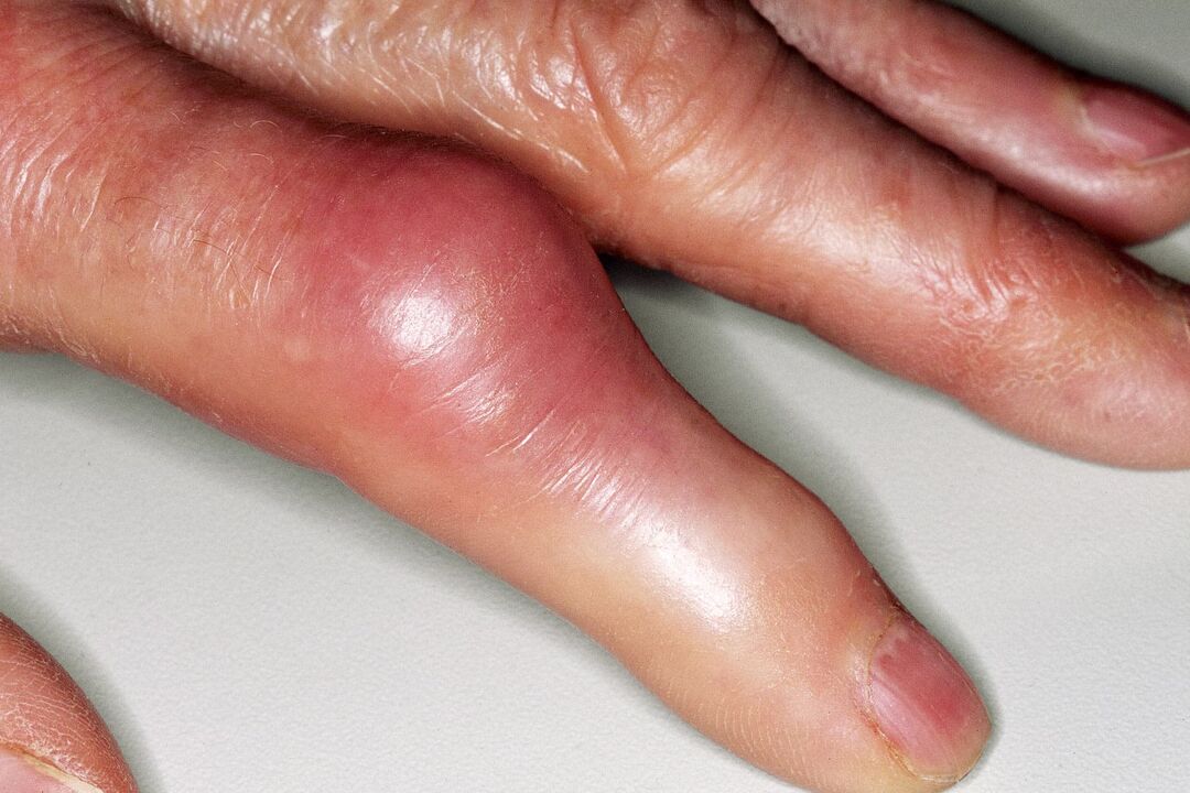 Inchazo, deformación da articulación do dedo e dor aguda despois dunha lesión