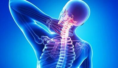 Síntomas e tratamento da osteocondrose do pescozo
