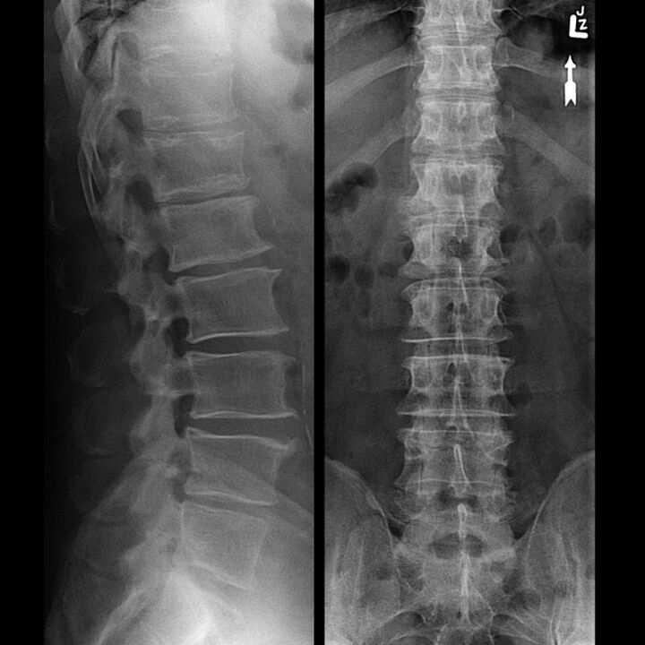 Returación da columna vertebral con osteocondrose