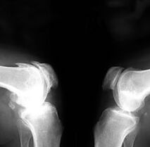 Osteoartrite nas radiografías