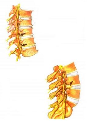 Ilustración da osteocondrose espinal